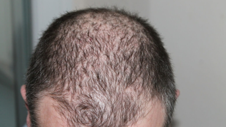 Causes of Hair Loss 