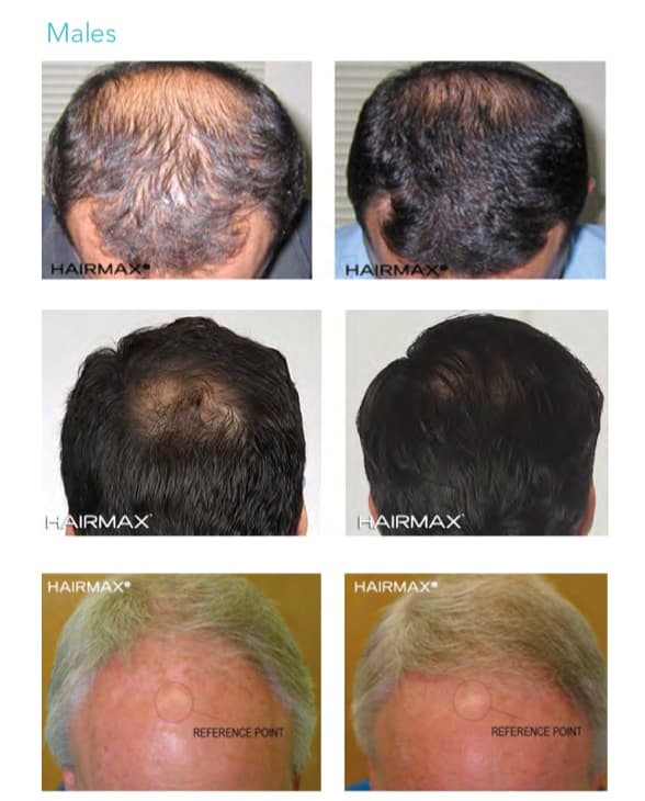 Hair Max Regrowth